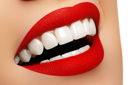 Porcelain Veneers